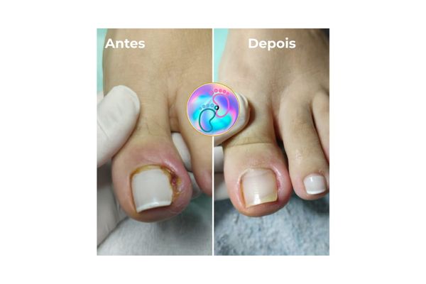 Foto de antes e depois do tratamento 30
